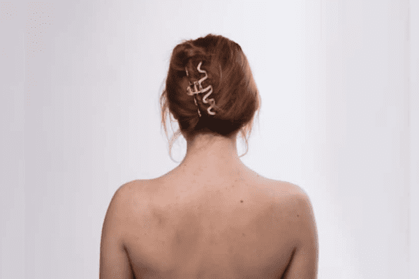 Struggling With Back Acne? Try These 10 Natural Home Remedies That Actually Work | Health News Struggling With Back Acne? Try These 10 Natural Home Remedies That Actually Work | Health News