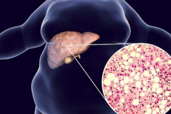 The Role Of Diet And Early Detection In Reversing Fatty Liver Disease | Health News The Role Of Diet And Early Detection In Reversing Fatty Liver Disease | Health News