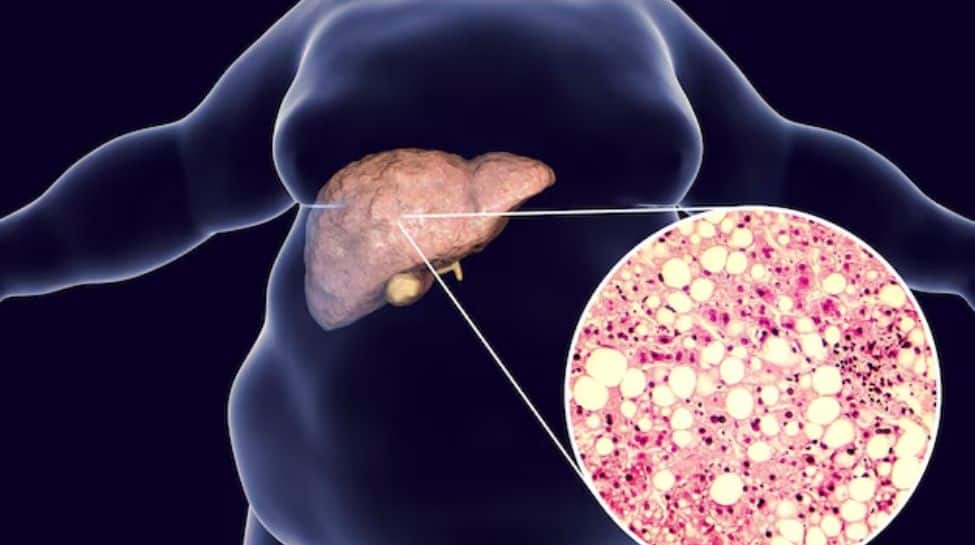 The Role Of Diet And Early Detection In Reversing Fatty Liver Disease | Health News The Role Of Diet And Early Detection In Reversing Fatty Liver Disease | Health News