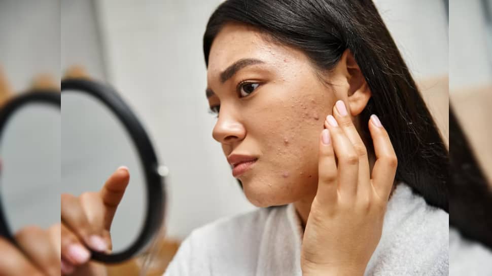 Say Goodbye To Pimples In 24 Hours: 8 Safe And Fast-Acting Methods That Help | Beauty/Fashion News