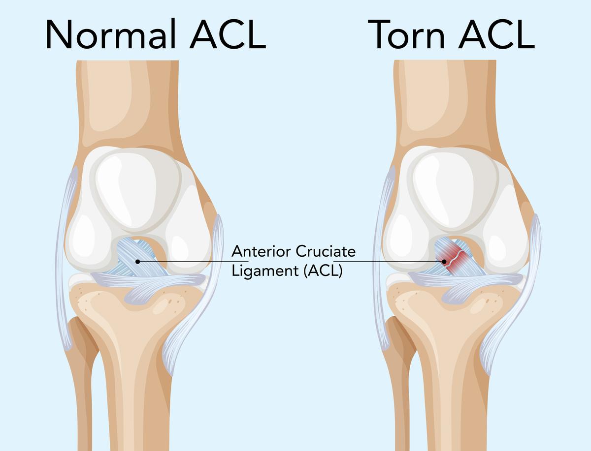 Women’s EURO 2025: ACL research in women’s football needs to focus on prevention over cure
