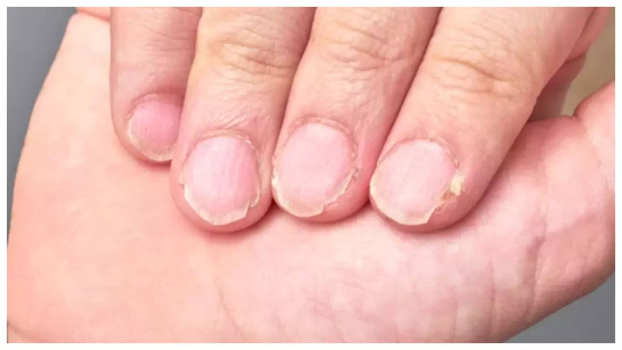 5 diseases that nails can reveal 5 diseases that nails can reveal